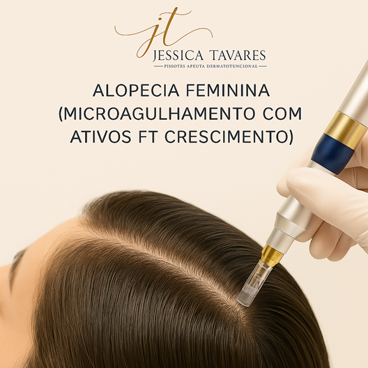 ALOPECIA FEMININA (MICROAGULHAMENTO COM ATIVOS FT CRESCIMENTO)