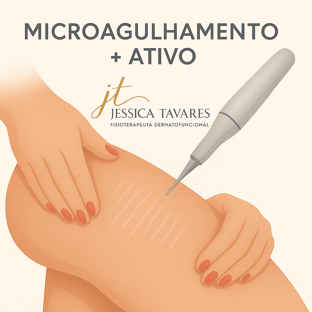 MICROAGULHAMENTO + ATIVO