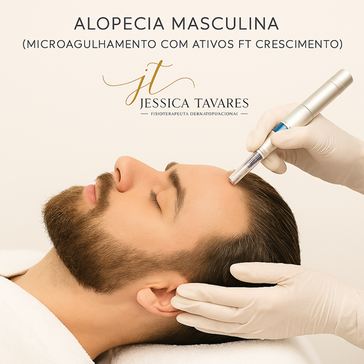 ALOPECIA MASCULINA  (MICROAGULHAMENTO COM ATIVOS FT CRESCIMENTO)